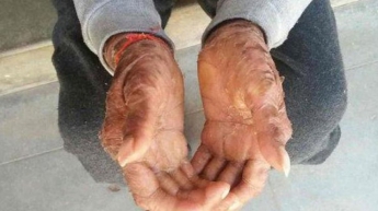 В Индии девочка-змея сбрасывает кожу каждые полтора месяца (фото)