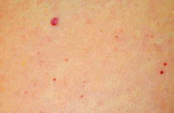 Красные точки на коже: заболевание или косметический дефект?