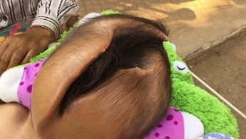 В Камбодже живет ребенок с трещиной в голове, которая постоянно растет