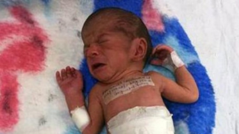 В Индии родилась девочка со второй головой (фото)