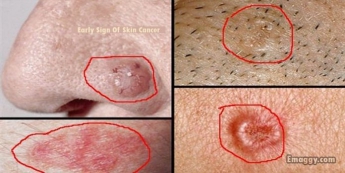 Ранние признаки рака кожи, которые Вы должны знать!
