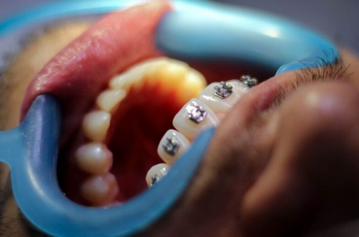 Женщина ворвалась в кабинет стоматолога и вырвала пациенту 13 зубов