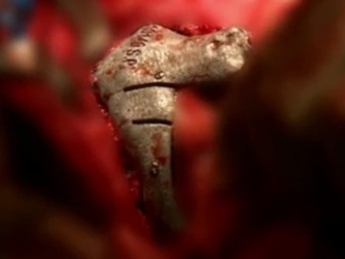 Британцу "распечатали" череп на 3D-принтере(видео)