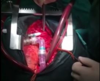 В Украине впервые пересадили механическое сердце (видео)
