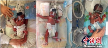 В Китае женщина родила близнецов через шесть дней после рождения сына
