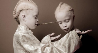 Близнецы-альбиносы из Бразилии покорили Интернет (фото)