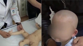 11-месячному мальчику успешно удалили третью ногу (фото)