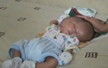В Индонезии родился ребенок с двумя лицами