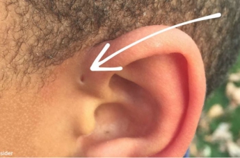 Почему некоторые люди рождаются с крошечными отверстиями в ушах