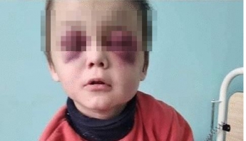 «Из-за гематом не мог открыть глаза»: на Винничине родители жестоко избили ребенка (Фото)