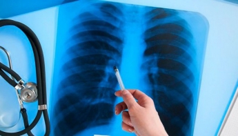 В Запорожской области у школьника и пенсионера обнаружили открытую форму туберкулеза