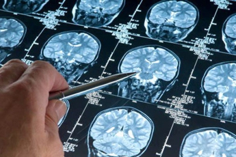 Хворі на рак головного мозку назвали перші симптоми хвороби, які не сприйняли всерйоз