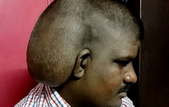 В Индии мужчине удалили огромную опухоль на голове
