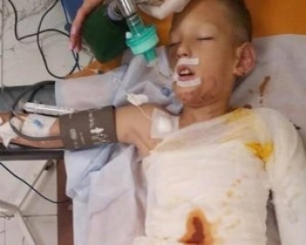 У Дніпрі діти облили бензином і підпалили 8-річного хлопчика