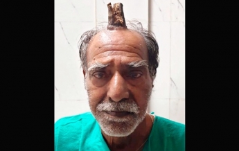 Индийцу удалили из головы 10-сантиметровый рог (фото)