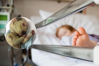 Малыша с редким "синдромом вампира" бросили в больнице: фото 18+