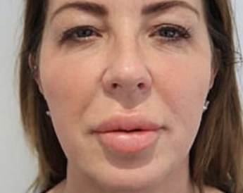 Шотландке сделали неудачную операцию по увеличению губ: шокирующее фото