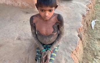 В Индии ребенок "окаменел" из-за редкой болезни (фото, видео)