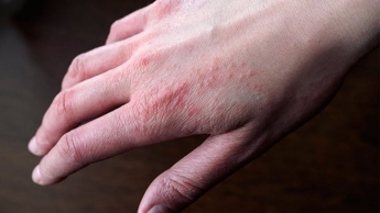 Красные пятна, шелушение - что делать, если у вас появилась аллергия на холод