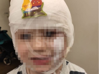 В Москве аниматор вылила сухой лед ребенку на голову: у мальчика сильнейшие ожоги