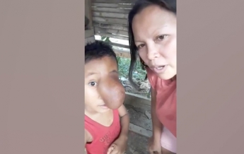 На Филиппинах у ребенка вырос "хобот" (видео)