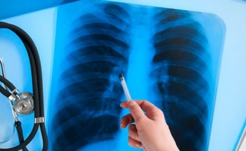 В Мелитополе 20 человек умерли от туберкулеза