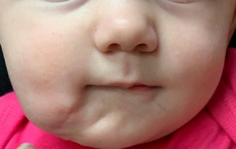 В США родилась девочка, у которой два рта (фото)