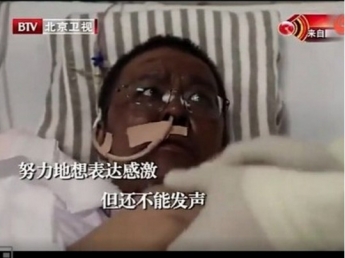 Умер 42-летний китайский врач, чья кожа почернела из-за коронавируса (фото)