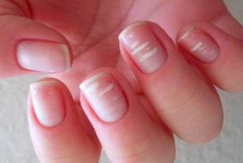 Бороздки и пятна: о каких опасных болезнях предупреждают ногти