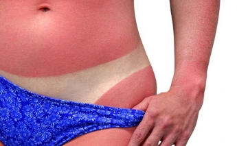 Не сметана - дерматолог рассказала, чем лечить солнечные ожоги