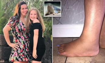 13-летнюю девочку на пляже "ужалила" рыба - палец сразу почернел, а нога распухла вдвое (фото)