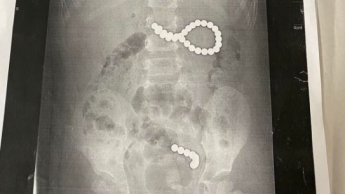 Под Львовом ребенок проглотил 36 магнитных шариков: врачи провели срочную операцию