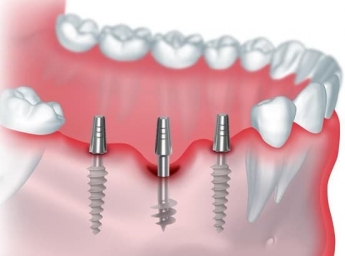 Имплантация зубов: безопасно ли ставить зубной имплант