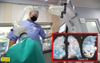 Украинские врачи показали фото легких больного COVID-19: разница поражает