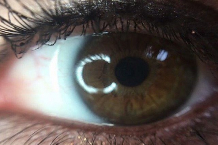Синдром сухого глаза: причины и симптомы заболевания