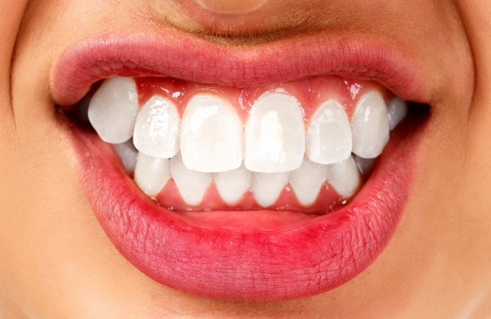 Сжатие зубов и скрежет: какой опасностью может обернуться бруксизм 