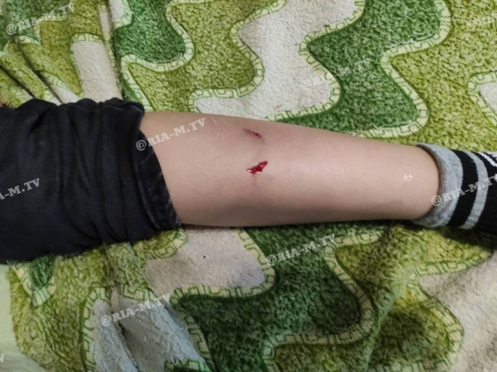 В Мелитополе стая собак напала на школьника и разорвала ногу (фото)