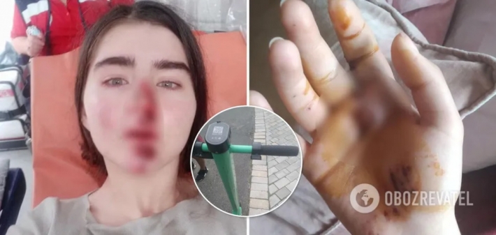 В Киеве девушка разбила лицо из-за неисправного самоката: за это ей предложили 200 гривен (Фото)