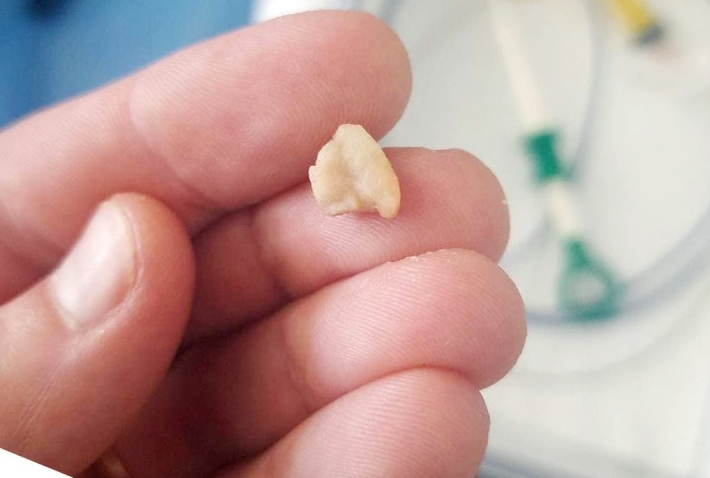В Запорожье из легких женщины достали зуб (фото)