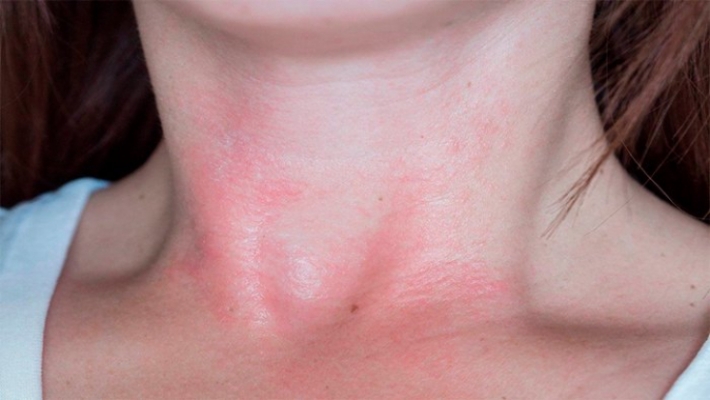 Красные пятна - что делать, если у вас аллергия на солнце