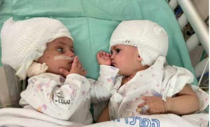 В Израиле успешно разделили сиамских близнецов (видео)