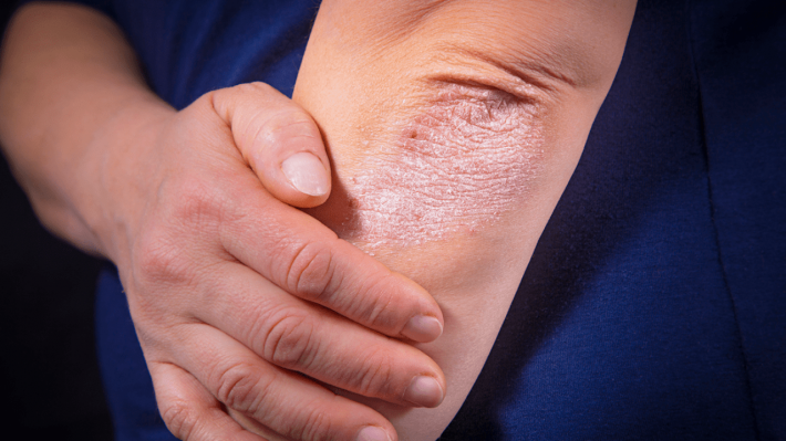 4 мифа о болезни: как псориаз поражает кожу и суставы