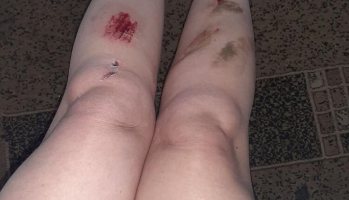 В Запорожье девушка травмировалась, упав в открытый люк (фото)