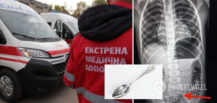 В Харькове 6-летний ребенок проглотил ложку: что известно о состоянии малыша (Фото)