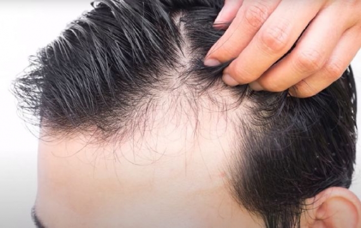 Остановит выпадение волос и ускорит рост: ученые назвали аптечное средство за 50 грн