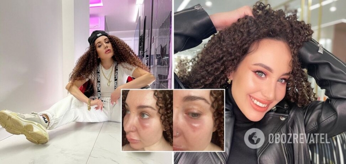 "Потею, кричу на всех, плачу": певица SHADU испугала сеть изуродованным лицом после косметолога (Фото)