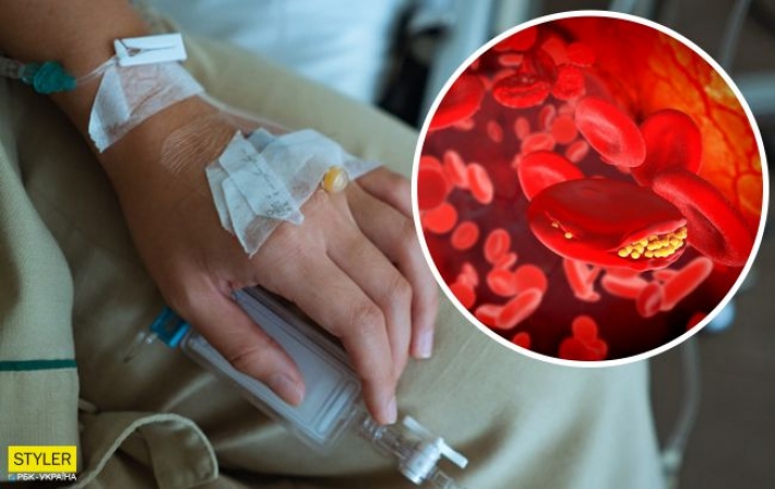 Украинцев предупредили о риске смерти от тромбоза вследствие коронавируса: названы симптомы