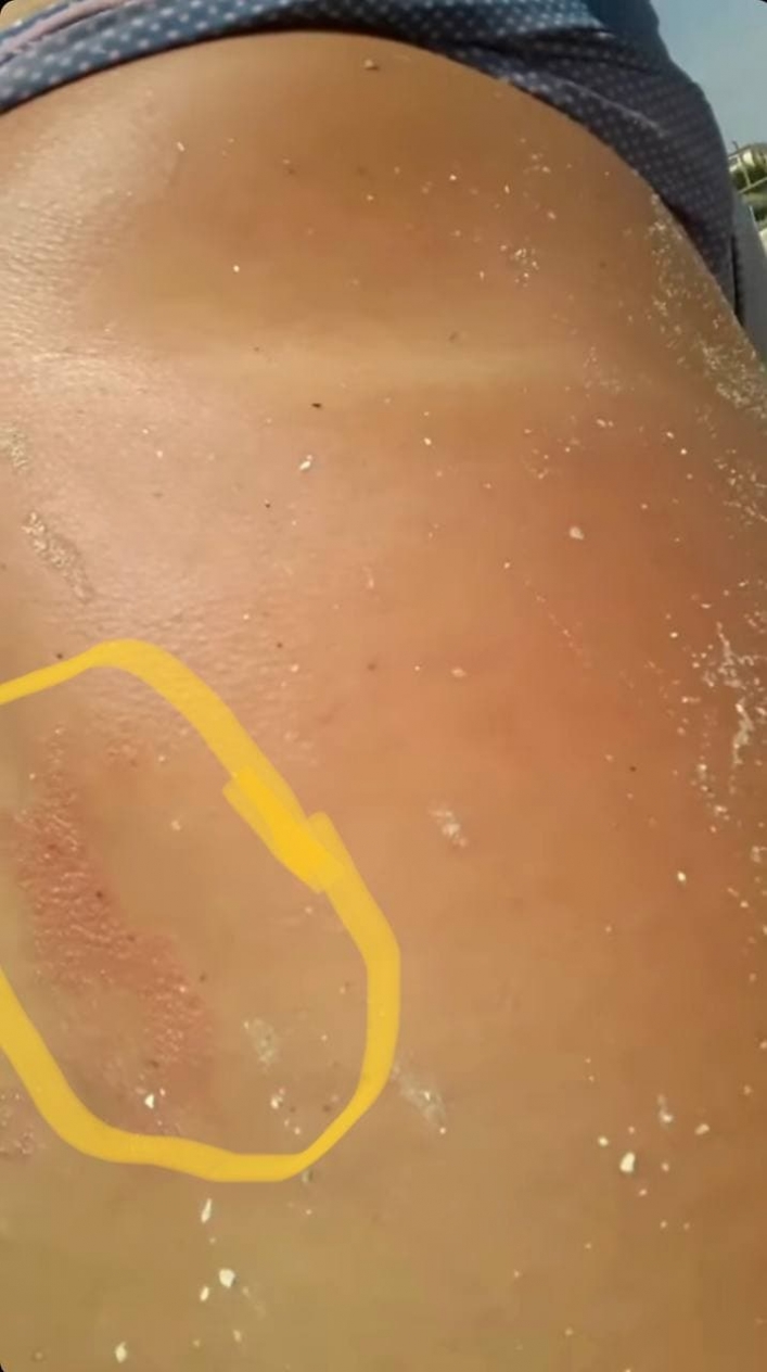 По спине пошли волдыри - женщина показала, какой бывает реакция на укус медузы (видео)
