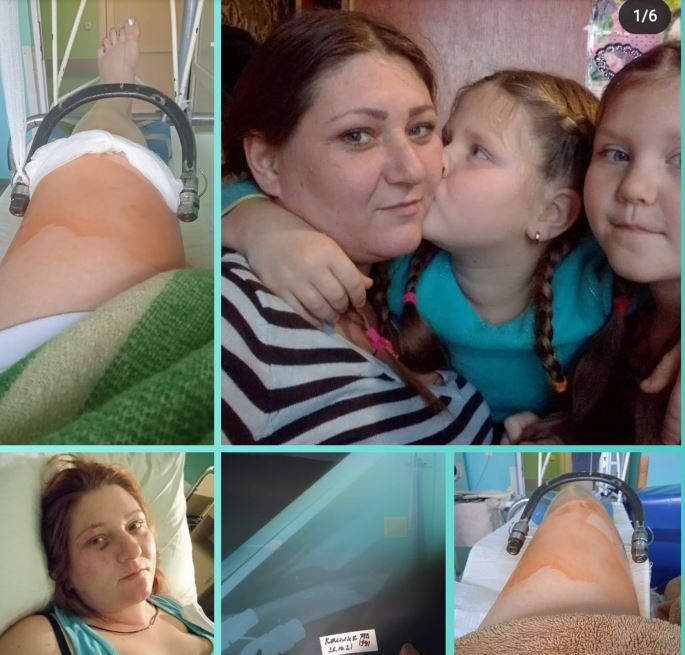 В Мелитопольском районе девушка может остаться инвалидом - нужна помощь