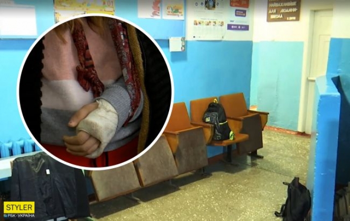 В школе под Одессой ученице на сломанную руку приложили рыбу и отправили домой: детали скандала